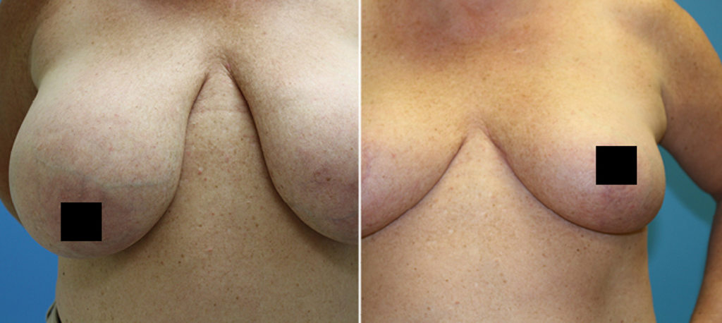 Penn Highlands Plastic Surgery Breast Surgery