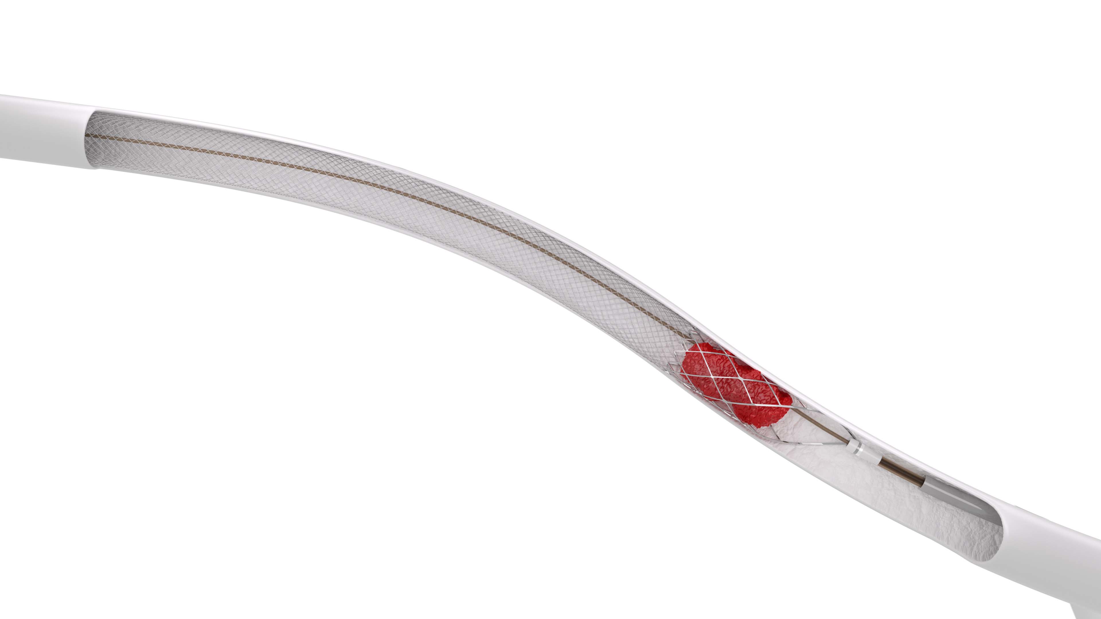 clottriever-inside-vessel.