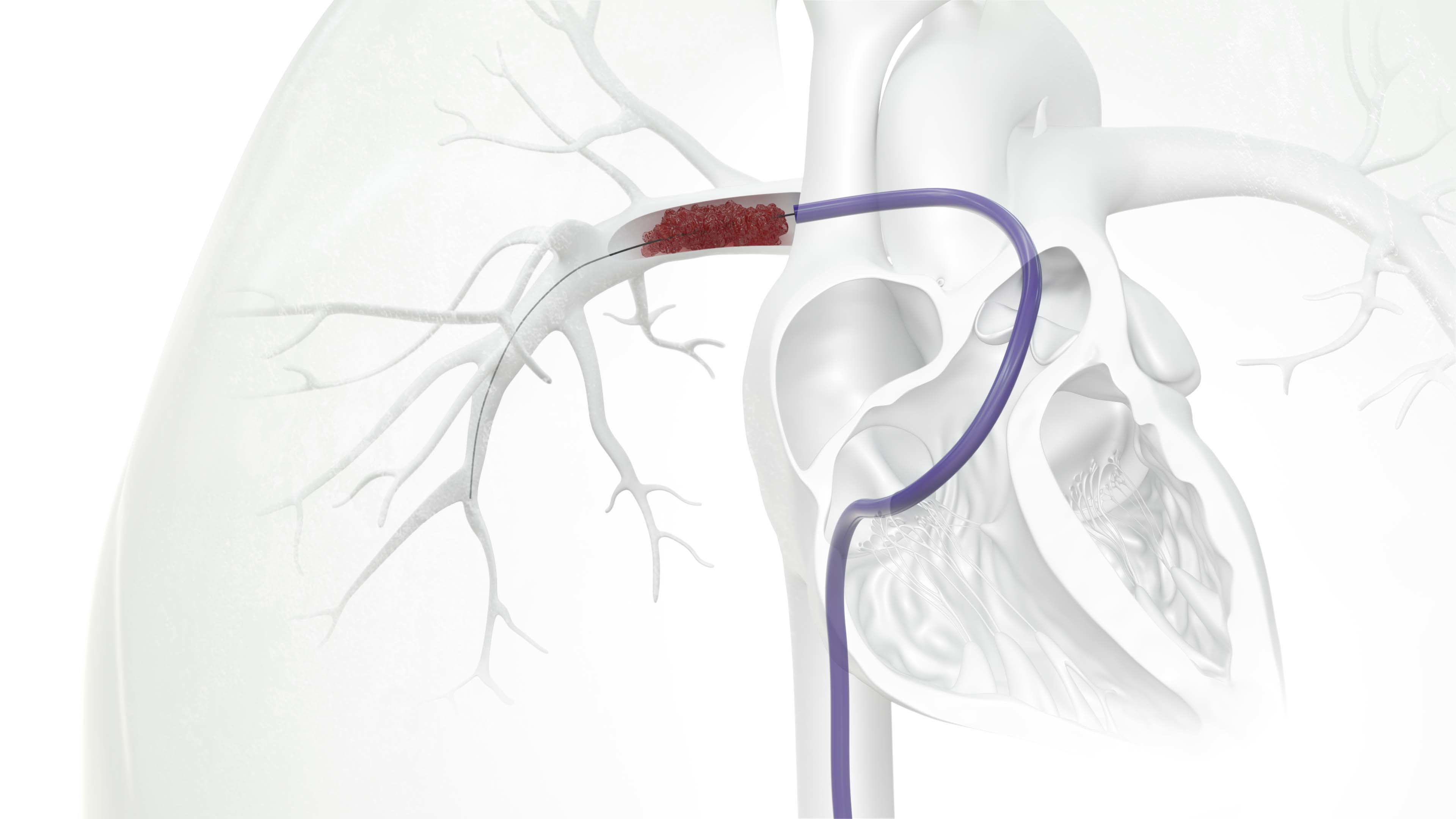 flowtriever-in-right-lung